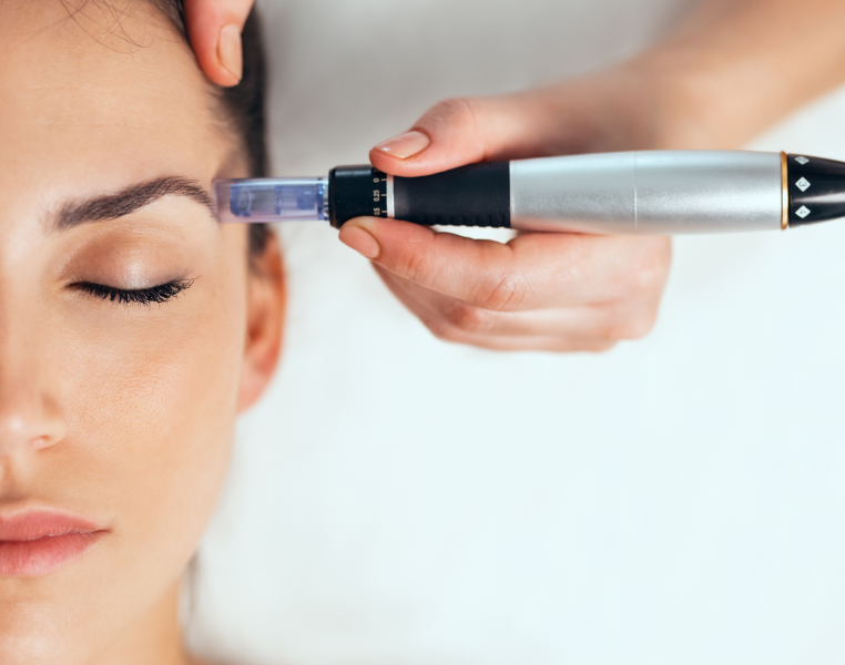 microneedling